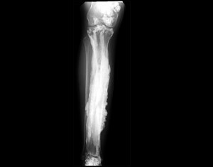 An x-ray image showing excess bone formation.
