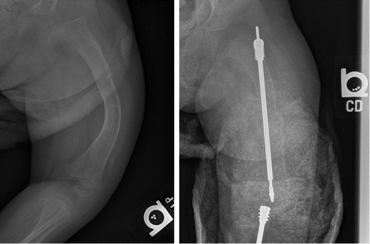 Typical bowed femur from an OI patient (left) which is often corrected by inserting a surgical rod (right).