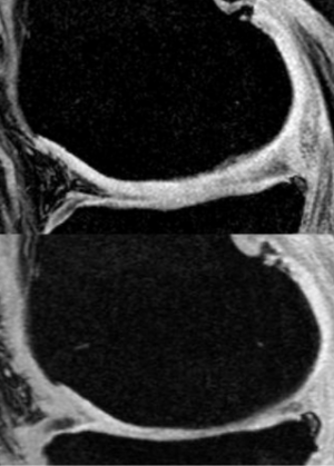 The knee cartilage of a patient with OA thins over time (upper panel: prior to treatment; lower panel: 2 years later, with corticosteroid injections to the knee every 3 months). Repeated corticosteroid injections to the joint may speed cartilage degeneration. 