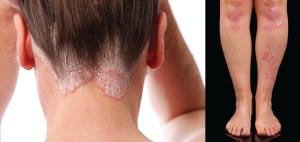 Psoriasis patches (or plaques) on the legs and the scalp characterized by silvery scales. 