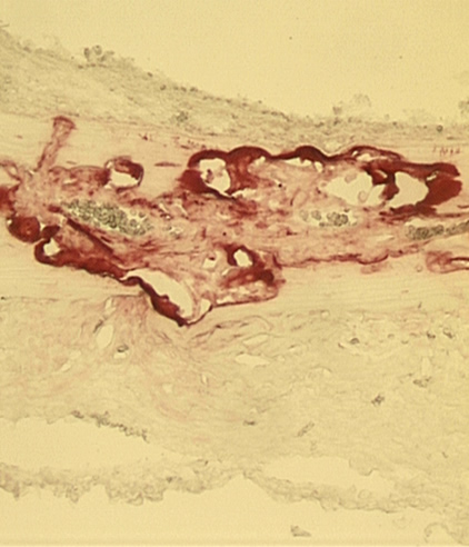 Enlarged image of bone showing osteoclasts (in red).