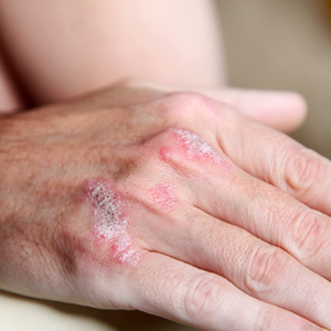 Photo of a hand showing psoriasis plaques.