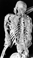 Skeleton of Harry Eastlack who had FOPs