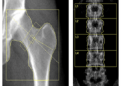 Researchers at the NIH examined scans of the hip and lower spine to determine the effects of hormone treatment on bone mineral density of women with primary ovarian insufficiency.