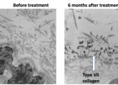 The image on the right shows the presence of type VII collagen in skin after gene therapy, compared to untreated skin on the left.