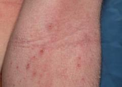 Eczema on arms