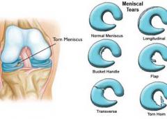 Anatomical illustration showing meniscus of knee