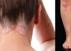 Psoriasis patches (or plaques) on the legs and the scalp characterized by silvery scales. 
