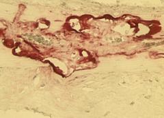 Enlarged image of bone showing osteoclasts (in red).