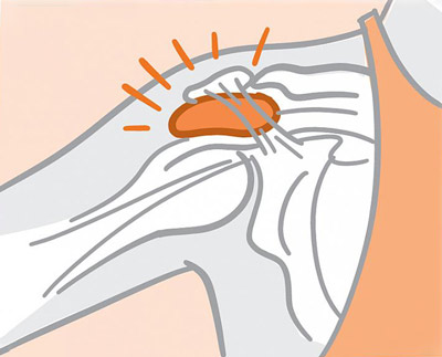 joint pain image