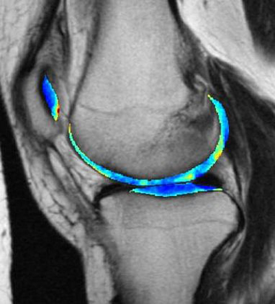 MRI scan of a knee