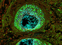 Keratin Skin Tumors cells