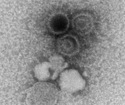 An electron microscopy image showing three Epstein-Barr virions.