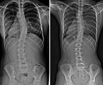 X-rays of a girl with adolescent idiopathic scoliosis