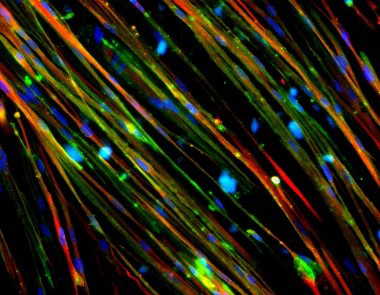 the restoration of dystrophin (stained green) in Duchenne muscular dystrophy (DMD) muscle cells