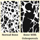 left shows scan of normal bone, right shows scan of bone with osteoporosis