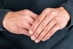 Person rubbing their hands while experiencing painful, itchy skin